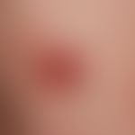 Melanom malignes, amelanotisches: seit Jahren bestehender rötlicher Knoten, der seit einigen Mona...