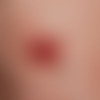 Melanoma malignes, amelanotic: a reddish lump that has existed for years, which has been constant...
