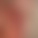 Melanoma, malignant, nodular: in the centre of the lesion of red surface smooth nodules with peri...
