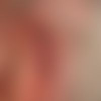 Melanoma, malignant, nodular: in the centre of the lesion of red surface smooth nodules with peri...