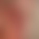 Melanom: im Zentrum der Läsion (eingekreist) Anteile des primär knotigen malignen Melanoms. Langs...