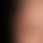Giant keratoakanthoma: 6 cm in diameter large, painless lump, which initially grew very quickly, ...