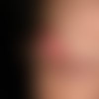 Giant keratoakanthoma: 6 cm in diameter large, painless lump, which initially grew very quickly, ...