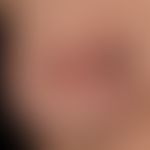 Giant keratoakanthoma: 4 cm in diameter large, painless lump with peripheral lip formation and ce...