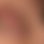 Riesenkeratoakanthom: initial typisches rasches Wachtumsverhalten, des symptomlosen Knotens. Seit...
