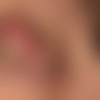 Riesenkeratoakanthom: initial typisches rasches Wachtumsverhalten, des symptomlosen Knotens. Seit...