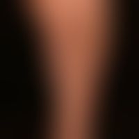 Pityriasis lichenoides et varioliformis acuta: acutely occurring "colorful" exanthema with differ...