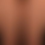 Pityriasis lichenoides et varioliformis acuta: acutely occurring "colorful" exanthema with papule...