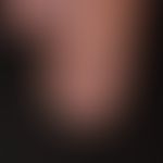 Melanonychia striata longitudinalis: approx. 0.2 cm wide, dark brown strip of the nail. nail fold...