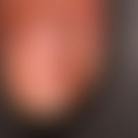 Melanonychia striata longitudinalis (2): control finding in 2016. widening of the longitudinal pi...