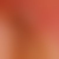 Melanonychia striata longitudinalis (2a): Control finding in 2016. detailed picture of the nail f...