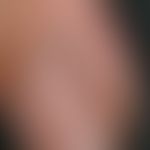 Melanonychia striata longitudinalis (1): Initial findings in 2009. Completely symptomless longitu...