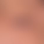 Keratoacanthoma centrifugum marginatum: large-area keratoacanthoma with central healing tendency ...