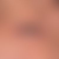 Keratoacanthoma centrifugum marginatum: large-area keratoacanthoma with central healing tendency ...