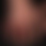 Gicht (Chiagra): seltener Befall der Fingergelenke bei einem akuten Gichtanfall (üblicherweise is...