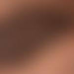 Nevus melanocytic dermal type: congenital, papillomatous melanocytic nevus Histological: dermal m...