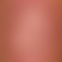 Tinea cruris (detailed picture): chronic plaque with a slightly faded central area, accentuated a...
