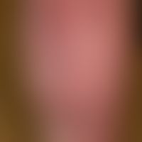 Tinea cruris: chronic plaque that is slightly faded in the centre, accentuated at the edges, cove...