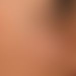 Naevus fuscocoeruleus ophthalmomaxillaris. Unregelmäßig begrenzte, flächenhafte, braune bis schwa...