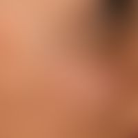 Naevus fuscocoeruleus ophthalmomaxillaris. Unregelmäßig begrenzte, flächenhafte, braune bis schwa...