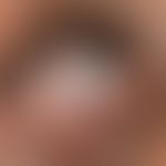 Naevus fuscocoeruleus ophthalmomaxillaris: blaugraue Verfärbung der Skleren und der unmittelbaren...