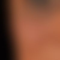 Naevus fuscocoeruleus ophthalmomaxillaris. Unregelmäßig begrenzte, flächenhafte, braune bis schwa...