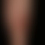 Lichen planus verrucosus: Itchy (see scratching effects with crust formation),verrucous plaques o...