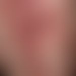 Lichen planus verrucosus: detailed view of the distal parts. marginal smaller partly solitary par...