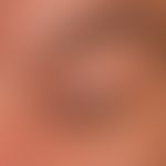 Lichen sclerosus extragenitaler: 45-year-old woman; since years existing striated Lichen sclerosu...