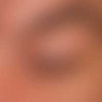 Lichen sclerosus extragenitaler: 45-year-old woman; since years existing striated Lichen sclerosu...