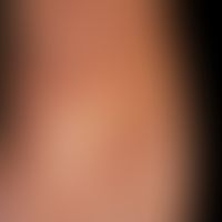 Lichen sclerosus extragenitaler: seit mehreren Monaten bestehende, völlig symptomlose, langsam pr...
