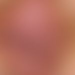 Lichen sclerosus (overview): a lichen sclerosus that has existed for many years; development of s...