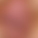 Lichen sclerosus with development of a squamous epithelial carcinoma: a lichen sclerosus that has...