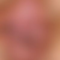 Lichen sclerosus with development of a squamous epithelial carcinoma: a lichen sclerosus that has...