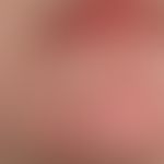 Narbe atrophische: Zustand nach abheilung eines chronischen diskoiden Lupus erythematodes.
