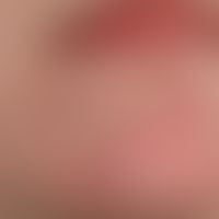 Narbe atrophische: Zustand nach abheilung eines chronischen diskoiden Lupus erythematodes.
