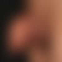 Lymphödem, sekundäres: akut aufgetretene pralle Schwellung des Penis bei Erysipel.
