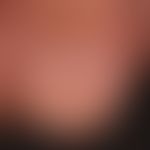 Melanonychia striata longitudinalis (initial findings): approx. 0.3 cm wide, light brown strip of...