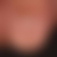 Melanonychia striata longitudinalis (initial findings): approx. 0.3 cm wide, light brown strip of...