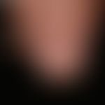Melanonychia striata longitudinalis (control finding 4 years later): approx. 0.4 cm wide, light b...