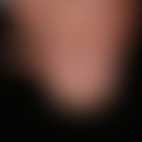 Melanonychia striata longitudinalis (control finding 4 years later): approx. 0.4 cm wide, light b...