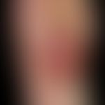 Nodules (lymphoma, cutaneous T-cell lymphoma, large-cell, CD30-positive): lymphoma known for a lo...