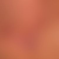Pemphigus chronicus benignus familiaris (detailed picture): multiple, chronically dynamic (changi...