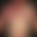 Vascular twin nevus: Kombination eines Naevus flammeus mit einem Naevus anaemicus.
