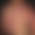Vascular twin nevus: Kombination eines Naevus flammeus mit einem Naevus anaemicus.
