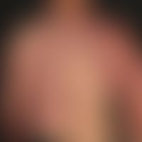 Vascular twin nevus: Kombination eines Naevus flammeus mit einem Naevus anaemicus.
