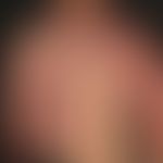 Vascular twin nevus: Kombination eines Naevus flammeus mit einem Naevus anaemicus. Eingekreist ei...