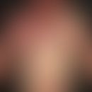 Naevus vascularis mixtus (Vascular twin nevus): Kombination eines Naevus flammeus mit einem Naevu...