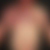 Naevus vascularis mixtus (Vascular twin nevus): Kombination eines Naevus flammeus mit einem Naevu...