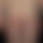 Naevus flammeus: angeborener, asymmetrisch angelegter, nicht-syndromaler (keine Gewebehypertrophi...